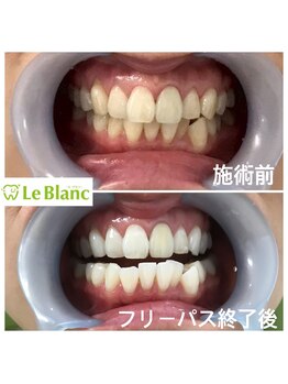 ルブラン 奈良店(Le Blanc)/気になる下の歯もしっかり白く