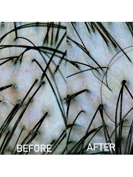 モモ 札幌(MOMO.)/ヘッドスパ後の毛穴の状態