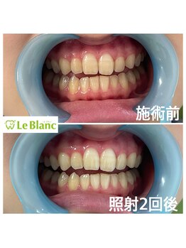 ルブラン 奈良店(Le Blanc)/初回で白さと艶を実感できる