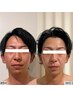 【メンズにオススメ】ポテンツァ×ハーブピーリング+ヘッドスパで清潔感UP♪