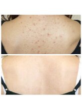 エステティックサロン S/背中のニキビケア、跡ケア