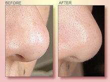 ジュリア オージェ 四条河原町店/ビフォーアフター（鼻スパ）