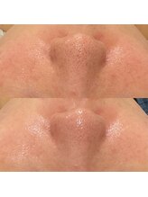 ラ クレール ビューティーサロン(LA CLAIR)/ハイドラ毛穴洗浄オプション