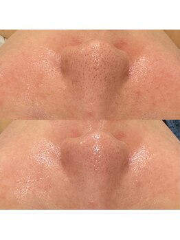 ラ クレール ビューティーサロン(LA CLAIR)/ハイドラ毛穴洗浄オプション