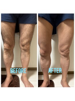 シェービーズ(shavys)/下半身脱毛