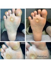 長岡巻き爪矯正センター/フットケアビフォーアフター
