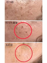 ヴィゴラス/シミケア