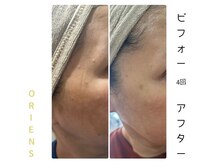 オリエンス(oriens)の雰囲気（老化の現象、稗粒腫もお任せください！トリプルショットで撃退☆）
