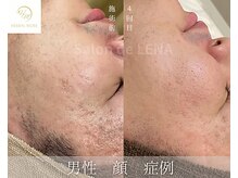 サロン ド レナ(Salon de LENA)/ハーブピーリング サロンドレナ