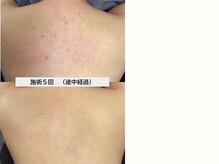 ニキビ研究所 千葉店/赤みや背中ニキビのお悩みの方