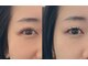 リコット バイ カシータ(Recot by casita)の写真/【瞼にアプローチ】特殊技術で瞼のリフトアップを叶えます。目元がスッキリした仕上がりに！