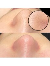 ティーティービューティー(TT Beauty)/毛穴エクストラクション