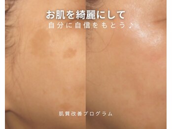 サラモ(Sa La Mo)/しみを改善なりたい肌を目指そう