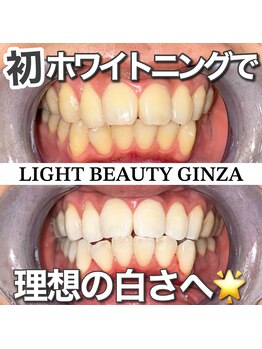 ライトビューティー 銀座店(LightBeauty)/東銀座　ホワイトニング症例写真