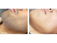 フィールフリー(Feel Free)/ヒゲのビフォーアフター