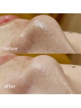 ルアナ(LUANA。)/毛穴洗浄ビフォーアフター#毛穴