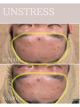 シンスプラス(SINCE+)/ハーブピーリング2週間後の肌