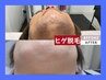 【見た目＆剃刀負け改善】メンズヒゲ脱毛★都度払いモニター¥12,000→¥7,500