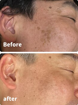 ヒカリ(Hikari)/しみケアビフォーアフター