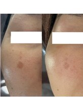 クリスタル(Crystal)/何歳からでも変われるシミケア