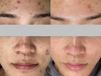 カプロ ボゥ(Capullo.Beau)/繰り返すニキビ集中改善