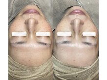 バーム(BAUM.)の雰囲気（差別化を図る毛穴ケア!道内希少道内各地から施術を求めて来店★）