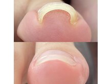 シーネイル(C Nail)の雰囲気（器具なし、見た目もキレイな巻き爪補正）