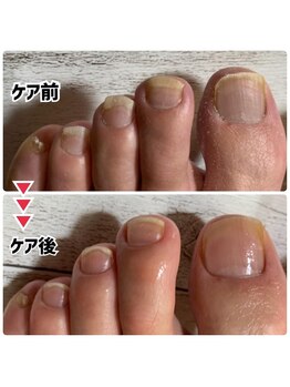 ユキネイル(YUKINAIL)/足の爪まわり、キレイにしましょ