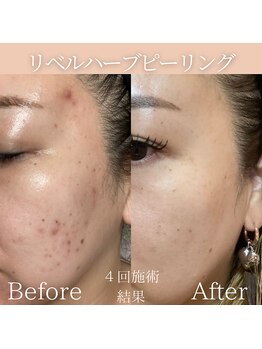 リフィール(Re:feel)/リベルハーブピーリング