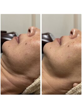 アン(An)/ピーリング+光美容