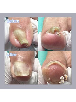 巻き爪補正店 天王寺店/巻きの強いお爪も諦めないで!