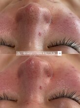 ジョワ 黒崎店(joie)/さよなら毛穴♪