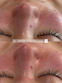 ジョワ 黒崎店(joie)/さよなら毛穴♪