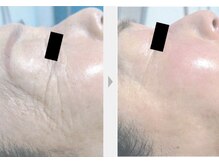 Nビューティー/最新RFサーモシェイプオーパス