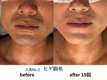 ノノケケ(NONOKEKE)/【メンズ脱毛】　ひげ脱毛