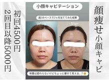 フェイシャル人気メニュー！小顔キャビテーション！