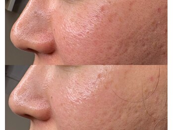 ル シーニュ/ホワイトスノーピール