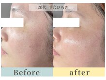 ムク(Muqu.)/カミソリで自己処理しないで！