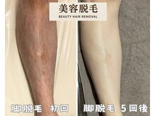 シエルエトワール 唐津店(Ciel Etoile)/美容脱毛　脚脱毛