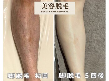 シエルエトワール 唐津店(Ciel Etoile)/美容脱毛 脚脱毛