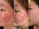 beauty salon 琴の写真/私自身が効果を実感した自慢の施術！自分の肌で試したこだわりのケアで理想の透明感へ♪