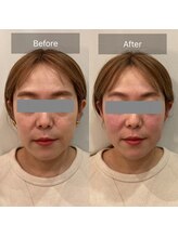 クレファ(CREFA)/美顔整骨症例