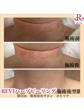 カピリナ(kapilina)/赤くなっていた部分の変化