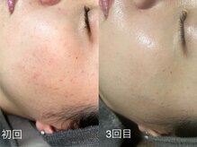 オルオル(oluolu)/復元パックで赤み改善＆美白
