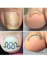 長岡巻き爪矯正センター/巻き爪矯正ビフォーアフター