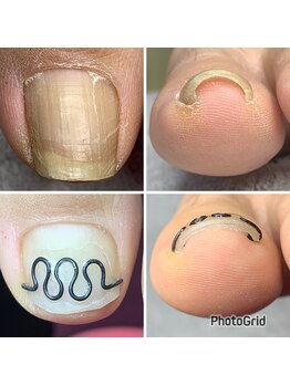長岡巻き爪矯正センター/巻き爪矯正ビフォーアフター