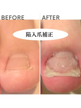 クオッカ(Quokka)/陥入爪ケア