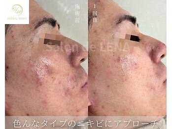サロン ド レナ(Salon de LENA)/ハーブピーリング サロンドレナ
