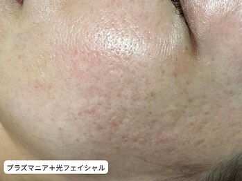 サロン アンネ(Anne)/プラズマニア＆光フェイシャル