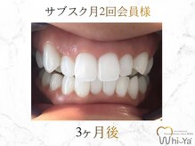 ホワイヤ セルフホワイトニング DBS神楽坂(Whi-Ya)/☆サブスク会員様☆納得の白さ☆